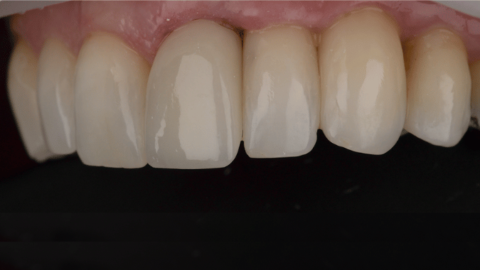 After - Circ Dental