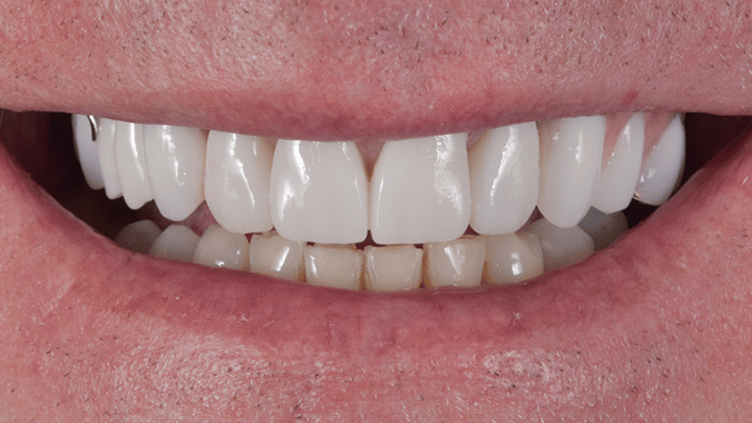 After - Circ Dental