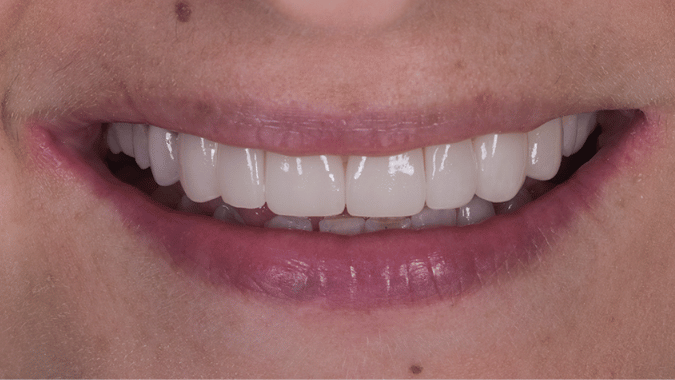 After - Circ Dental