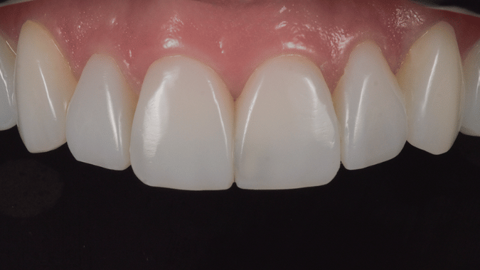 After - Circ Dental