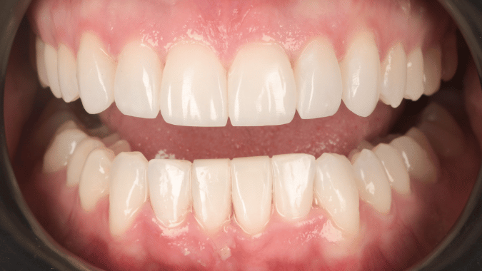 After - Circ Dental