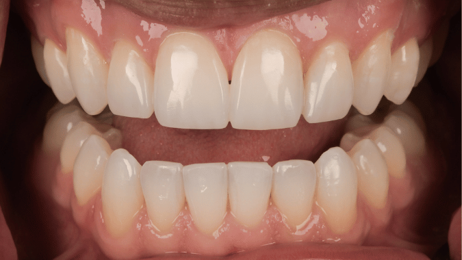 After - Circ Dental