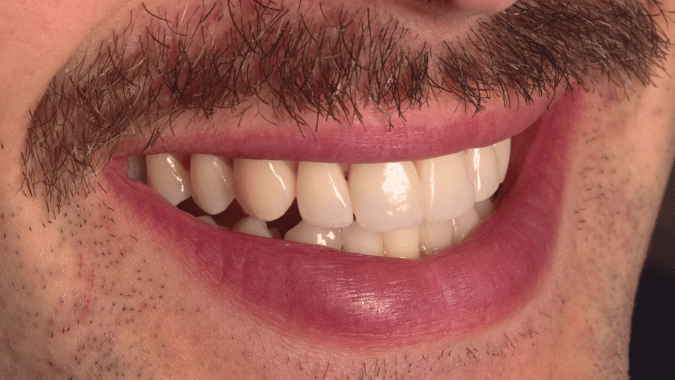 After - Circ Dental