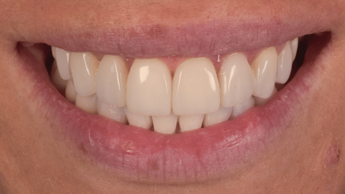 After - Circ Dental