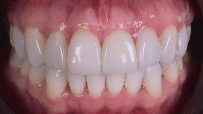 After - Circ Dental