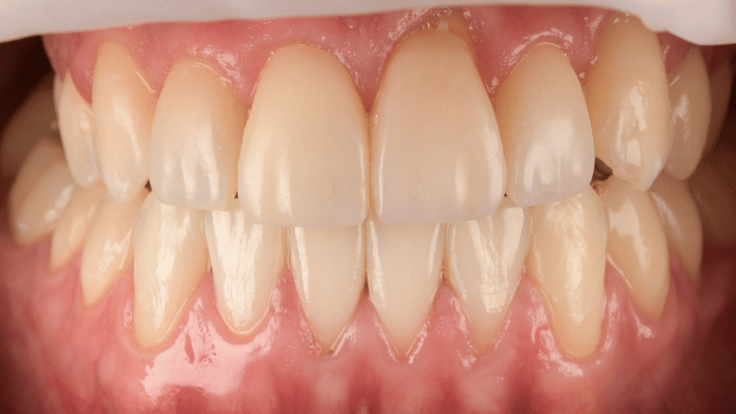 After - Circ Dental