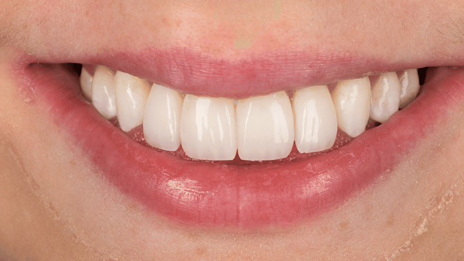After - Circ Dental