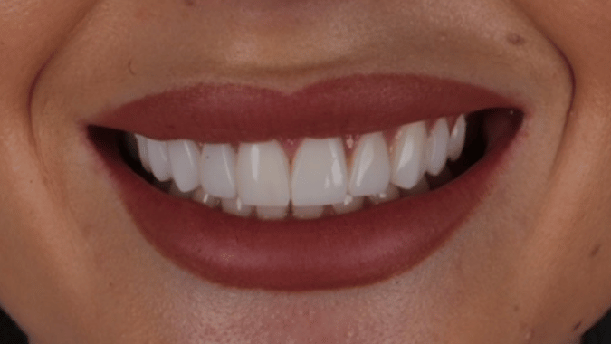 After - Circ Dental