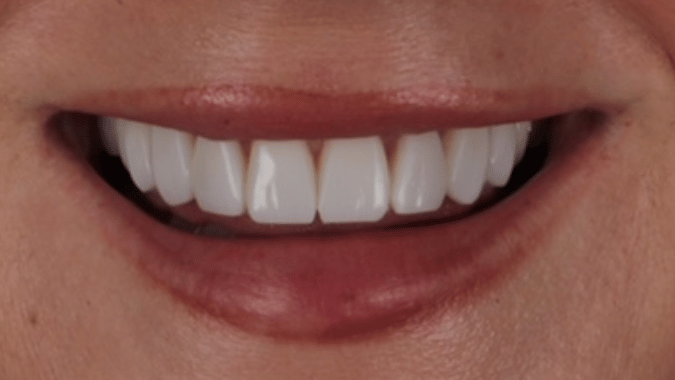 After - Circ Dental