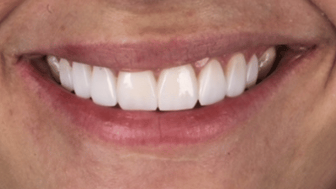 After - Circ Dental
