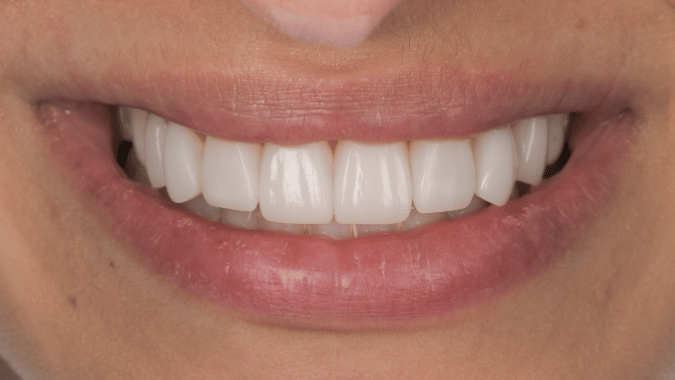 After - Circ Dental