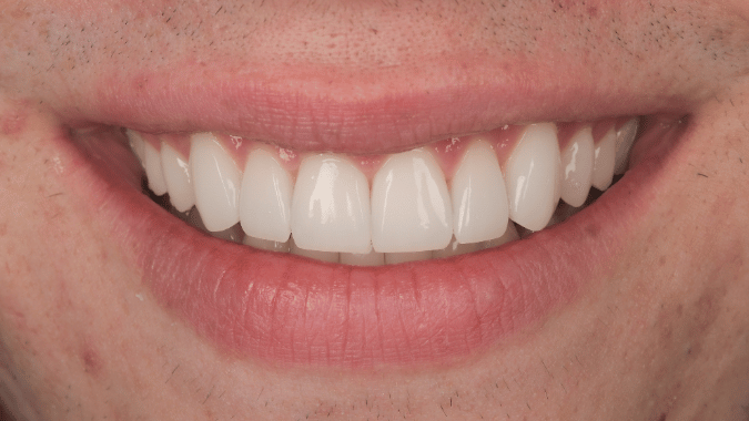 After - Circ Dental