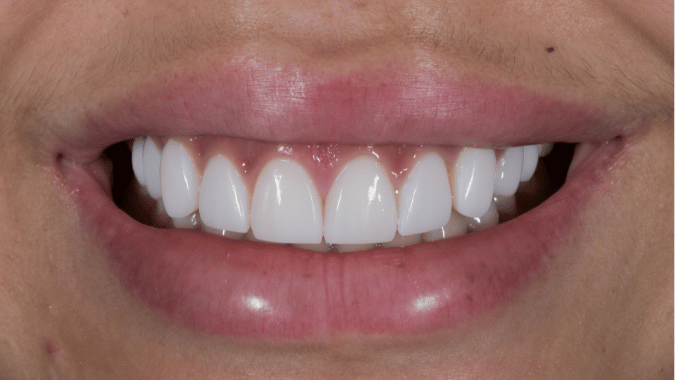 After - Circ Dental